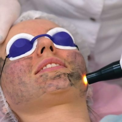 Carbon Laser3