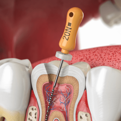 Root Canal3
