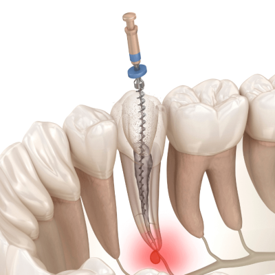 Root Canal4