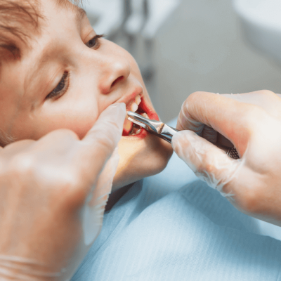 Teeth Extraction2